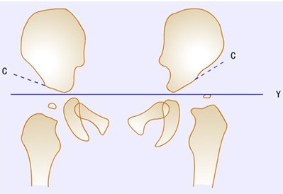 诊断髋关节发育不良的测量依据 好大夫在线