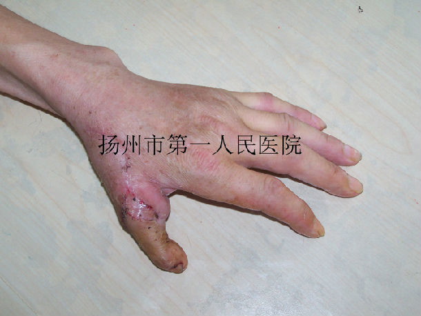 拇指再造(游离第二足趾移植)