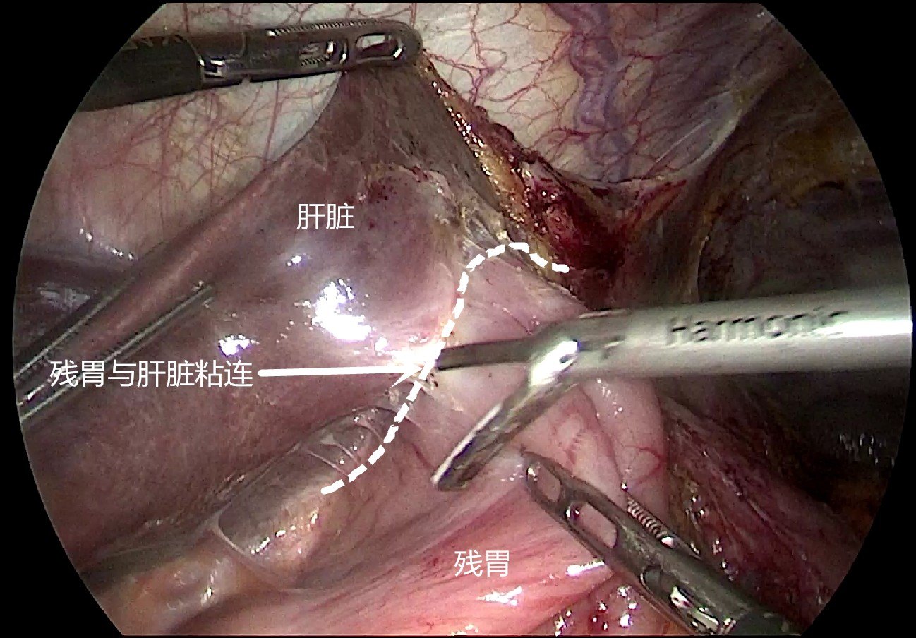 特殊病例:复发贲门癌的全腹腔镜下根治术