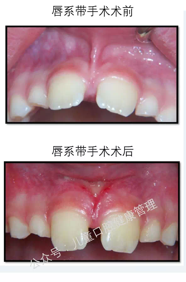 唇系带 (转载)