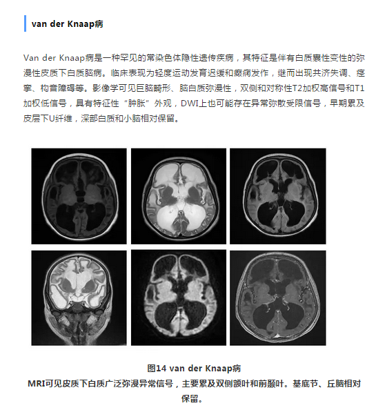 脑白质病变的鉴别诊断:皮层下u纤维的秘密
