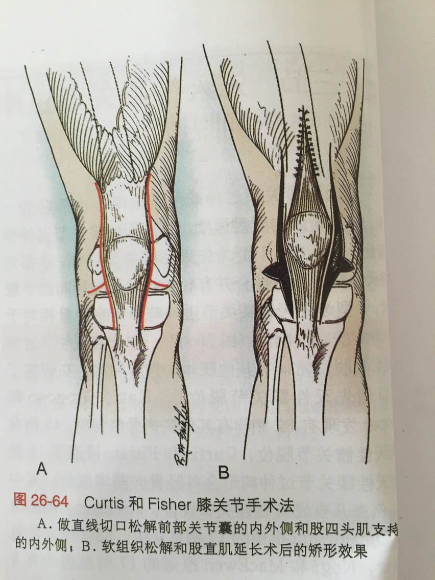 先天性膝关节过伸和脱位