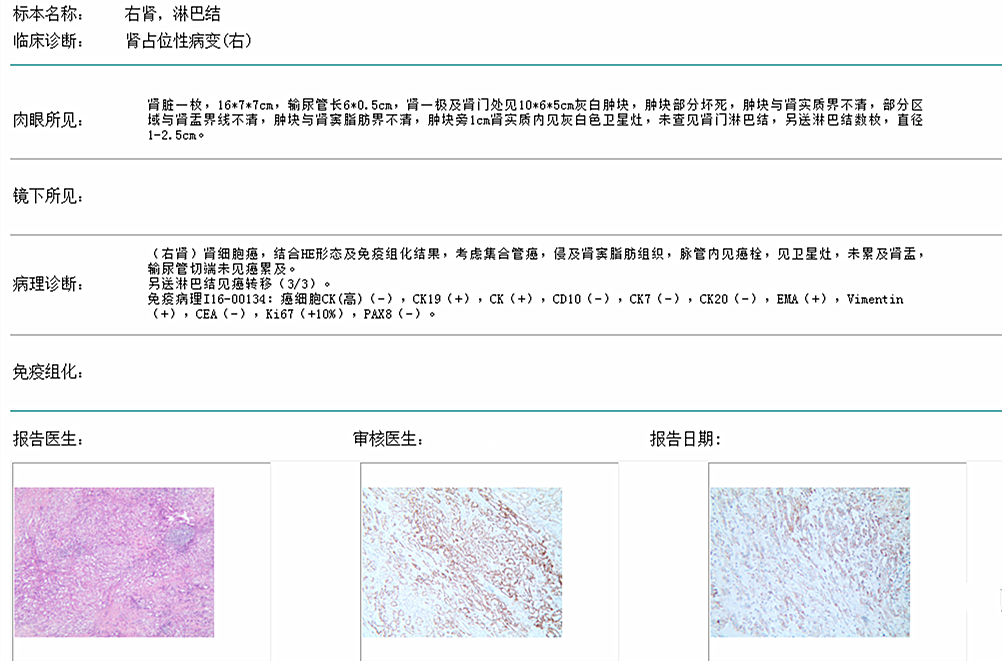 乳头状肾细胞癌,透明细胞癌,双侧肾癌的微创治疗进展