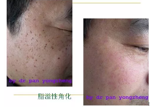 激光美白嫩肤价格_激光嫩肤美白多少钱_激光美白嫩肤有效吗