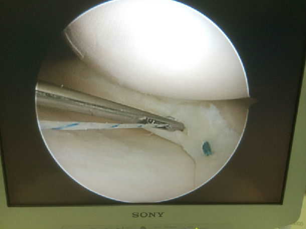 关节镜辅助下内侧半月板桶柄样撕裂缝合术
