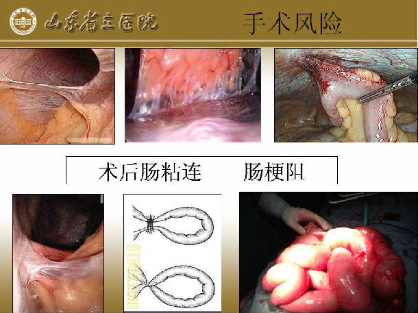 山东省立医院 朱化强 胆囊切除 胆管切开取石 t型