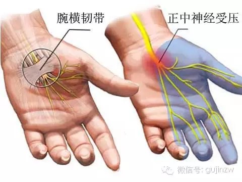 腕管综合征(晚上手掌麻木)不用开刀