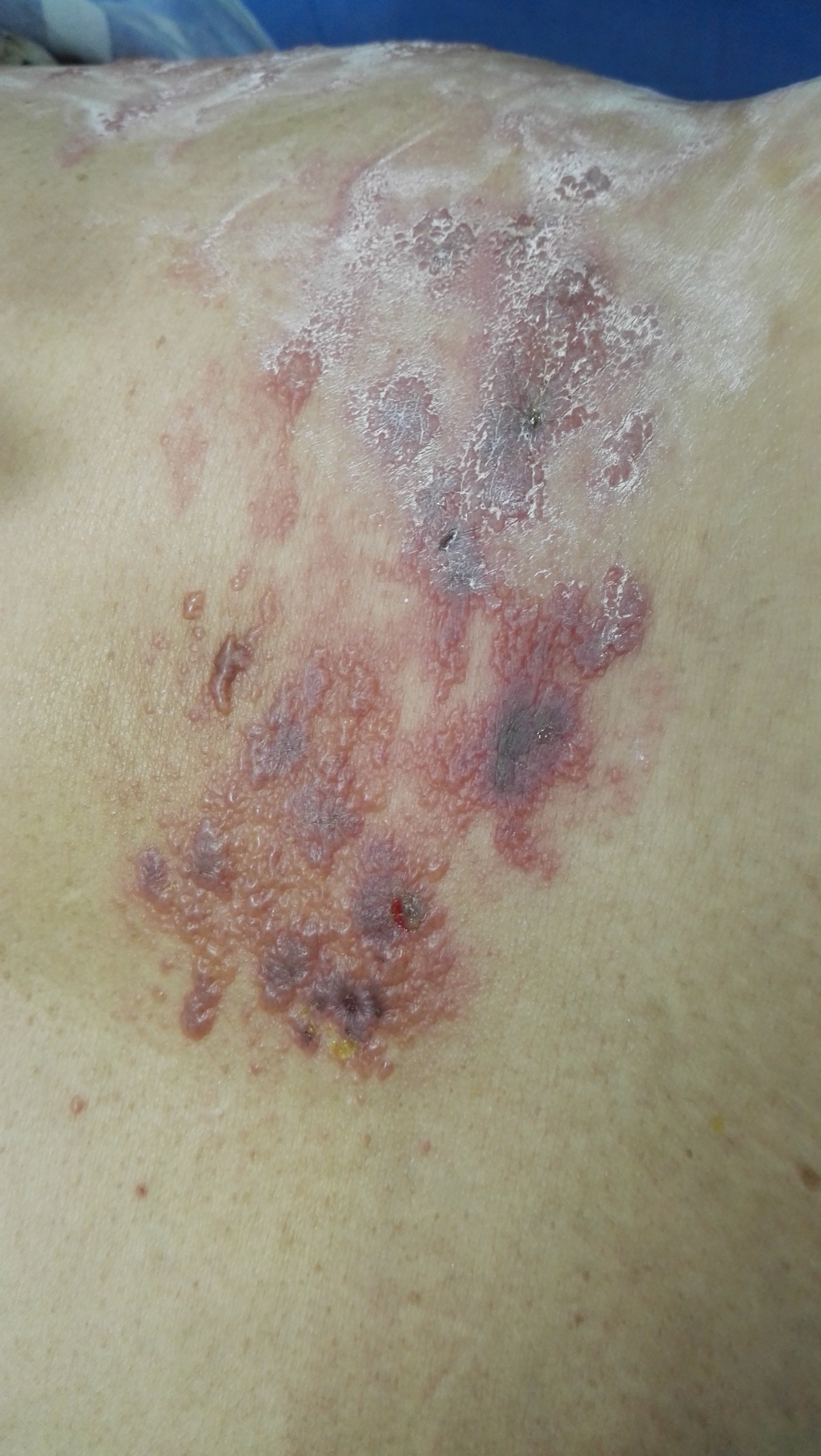 治阴茎疱疹最佳方法_疱疹三天自愈的最佳方法_三天治疗疱疹特效药