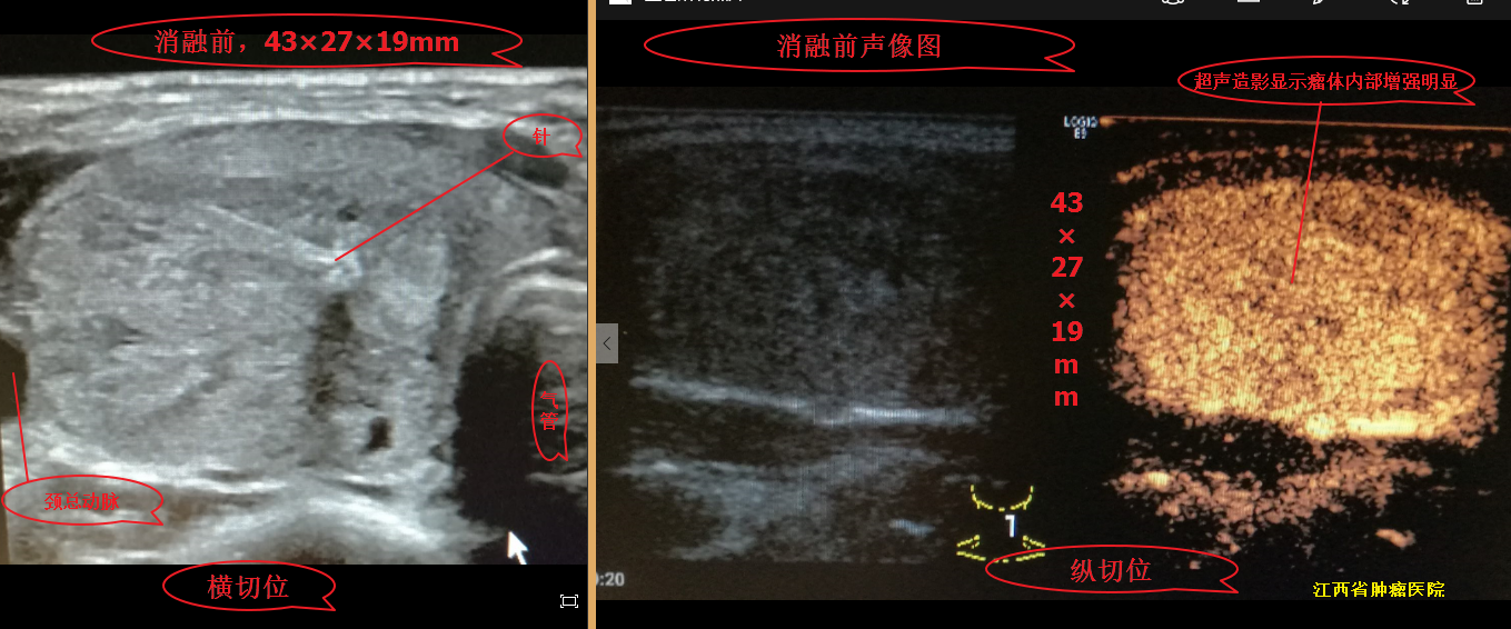 甲状腺结节微波消融术后,随访效果图!