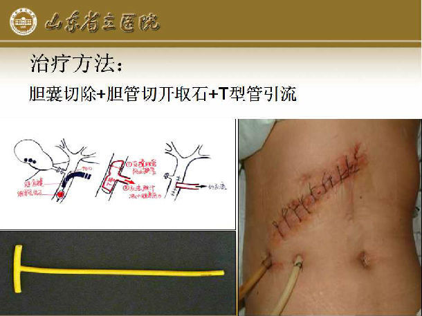 胆囊切除 胆管切开取石 t型管引流 手术须知