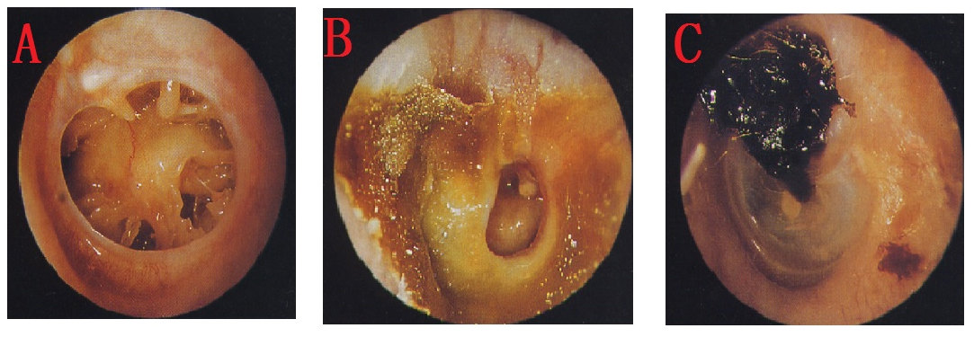 简单介绍三种类型的慢性化脓性中耳炎