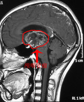 冠切右额开颅颅咽管瘤(钙化)切除术_好大夫在