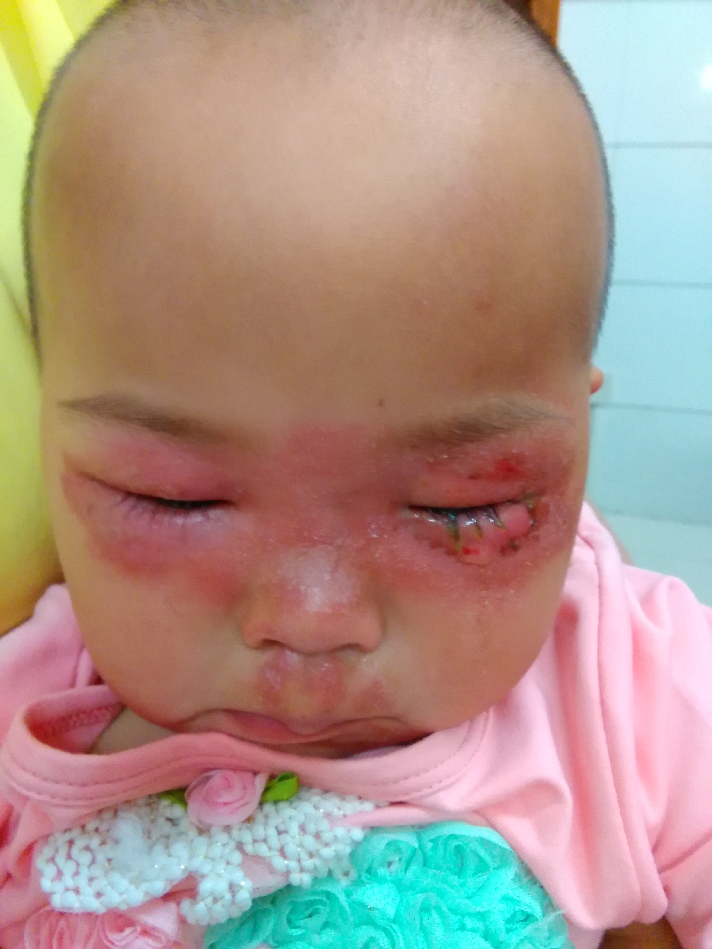 一个两岁的小孩子被隐翅虫咬到后入院前的眼部情况.