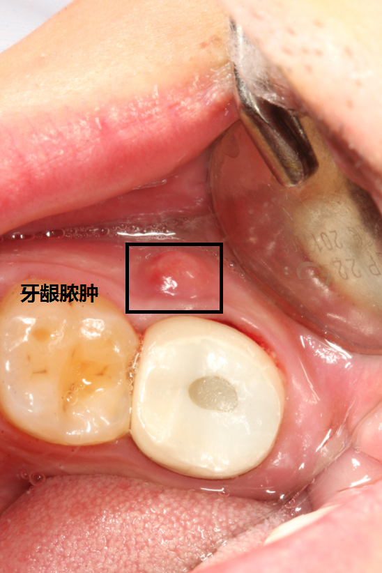 检查:全瓷牙冠修复,牙齿松动一度,叩痛明显,牙龈有脓肿.