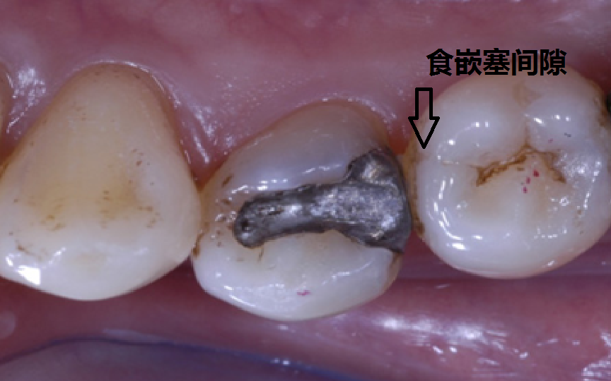 我是如何处理食物嵌塞