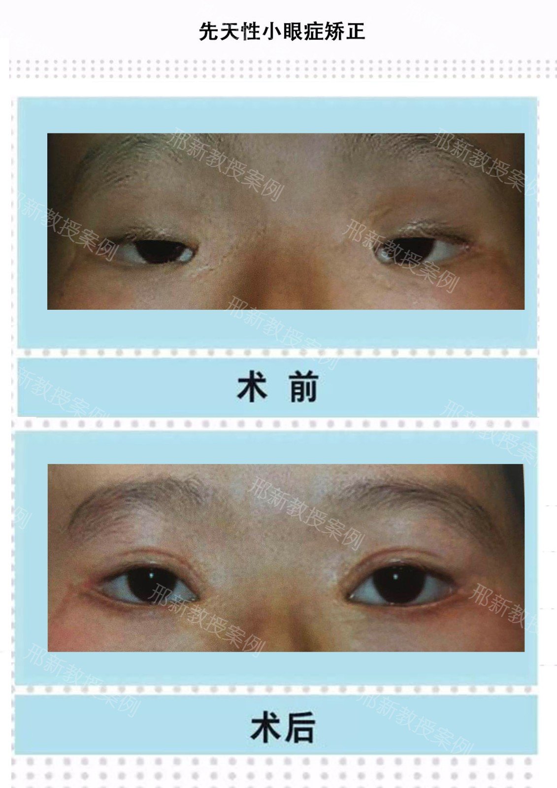 先天性 小眼 症,又称睑裂狭小综合征 blepharophimosis-plosis-epi