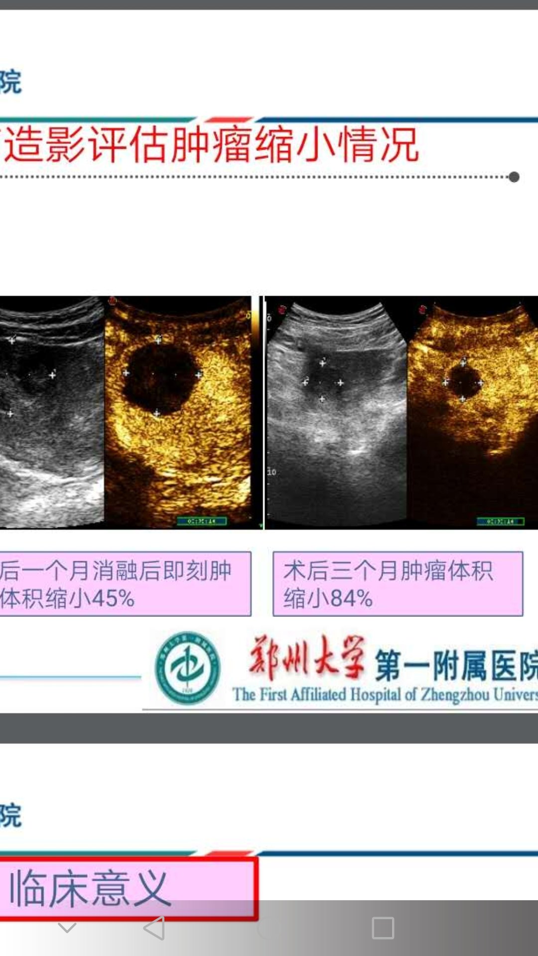 子宫内膜异位(子宫腺肌症)的治疗