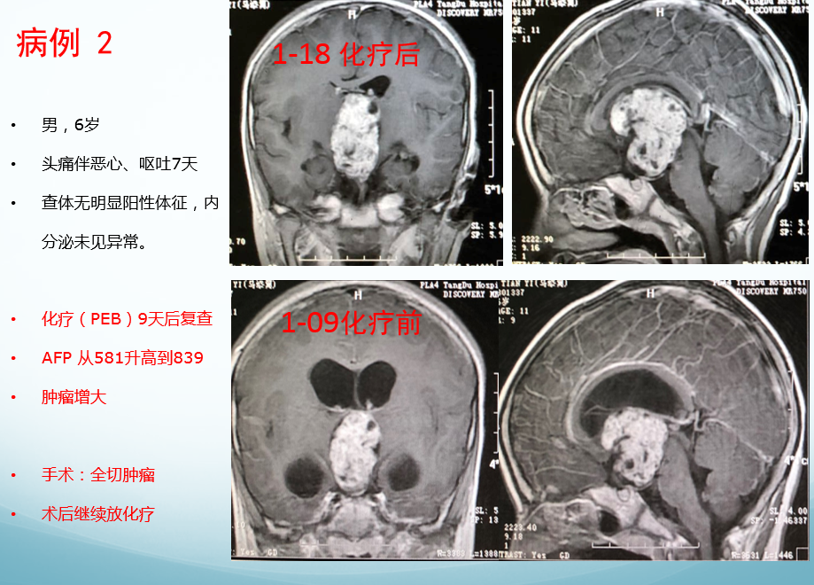 儿童颅内生殖细胞肿瘤病例分享