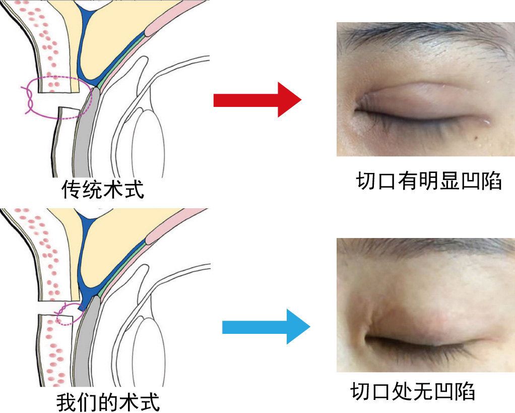 拥有完美翘睫毛的秘密——论眼轮匝肌睑板固定技术