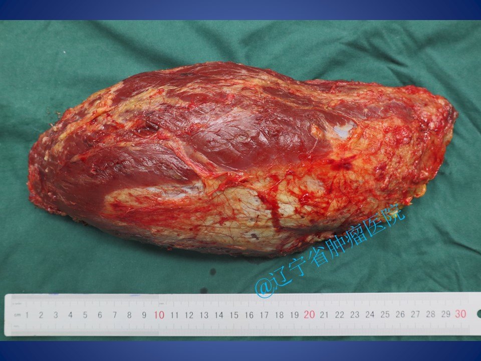 股部前侧肌群软组织肉瘤手术病例