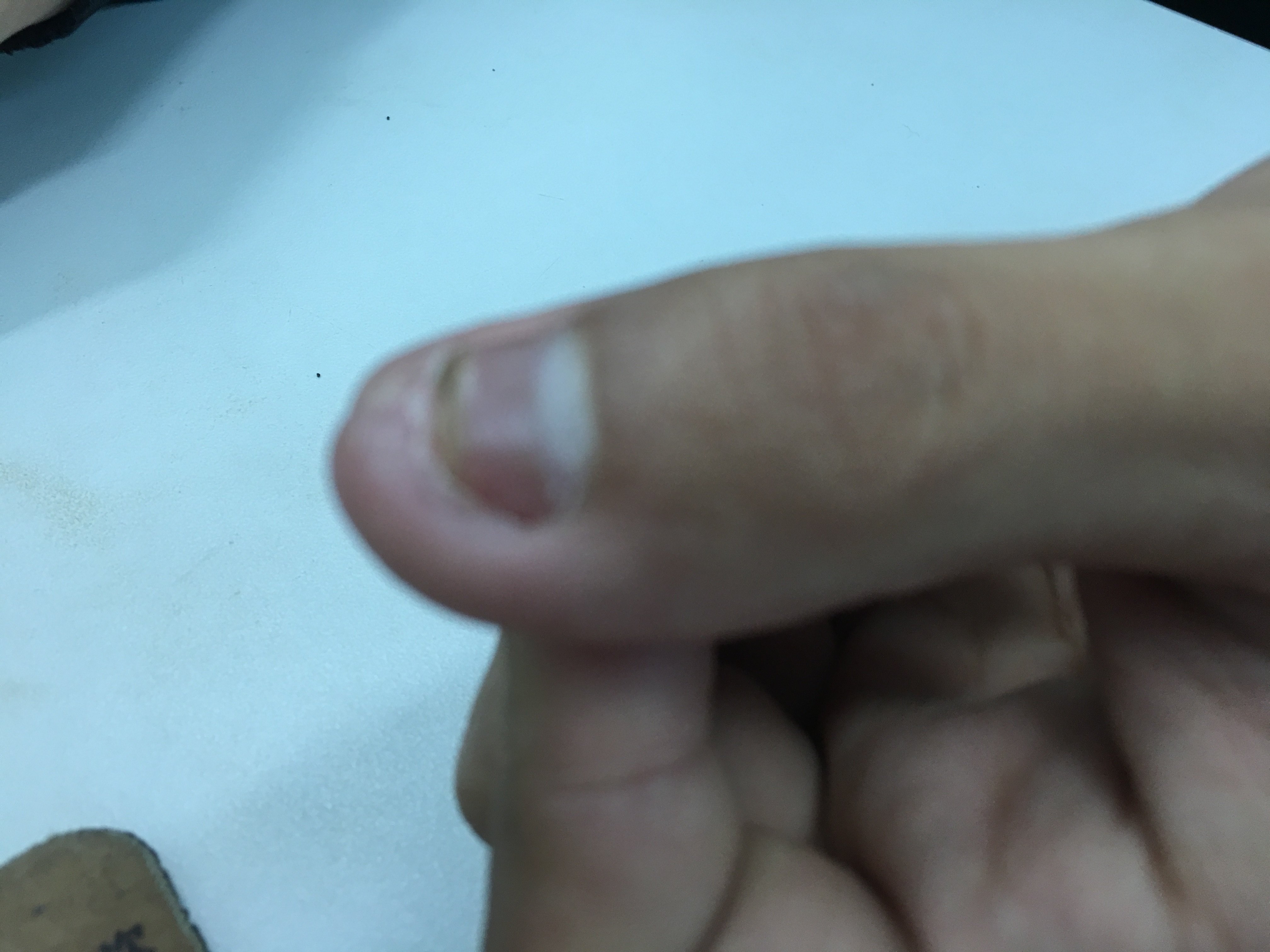 甲床损伤导致的手指甲畸形