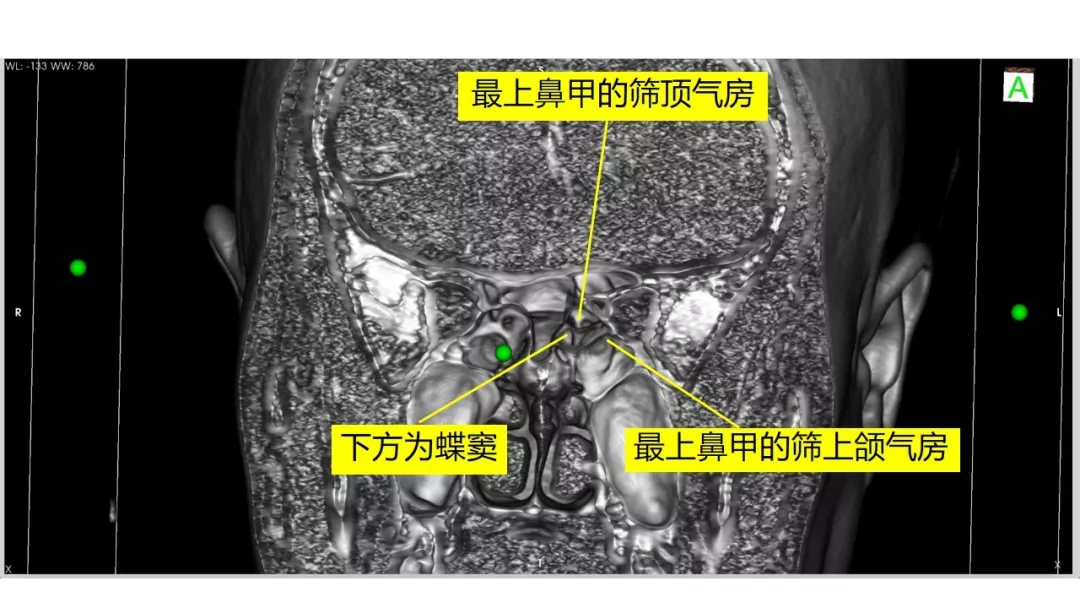 前床突磨除与脑积液漏处理-中鼻道经筛入路解剖,阅片与手术