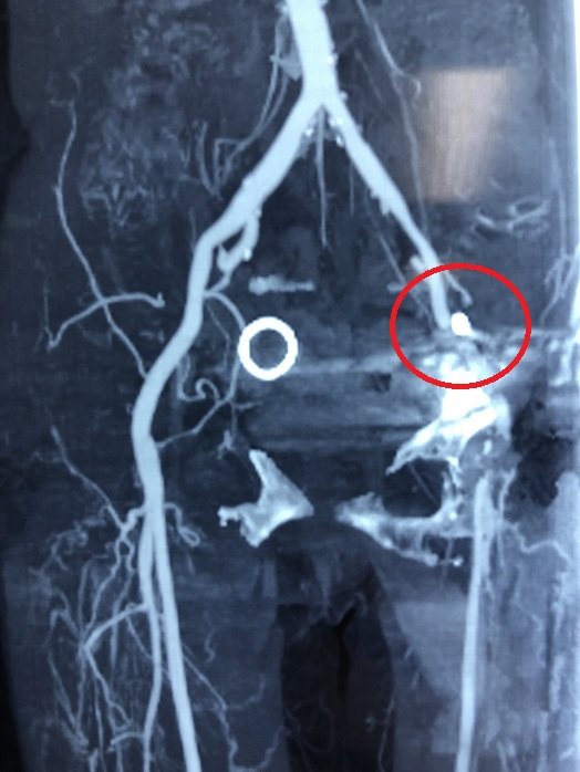 入院进行下肢静脉cta造影提示假体螺钉进入髂内动脉血管壁