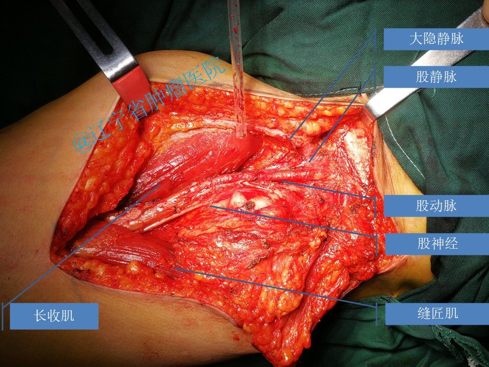 股三角区软组织肉瘤手术病例