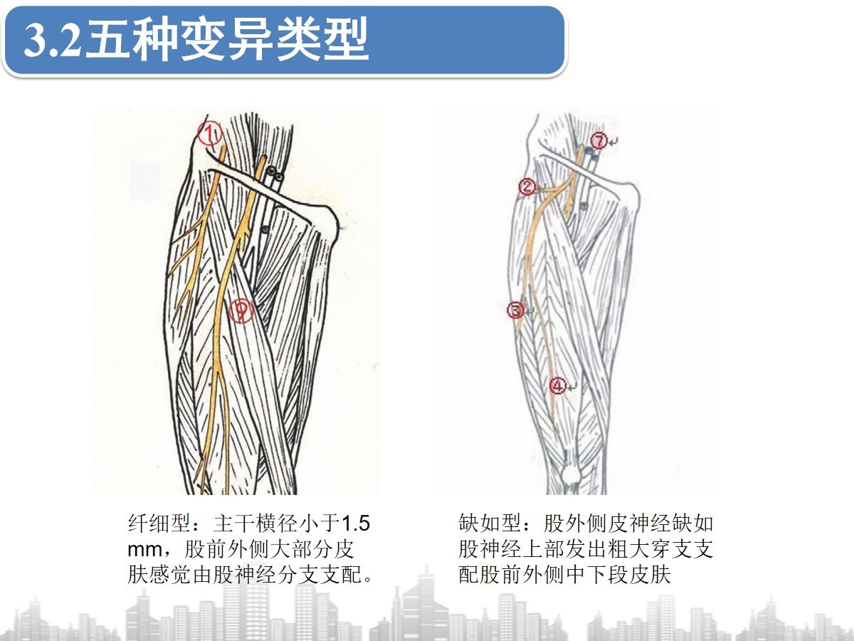 股外侧皮神经炎诊治概述