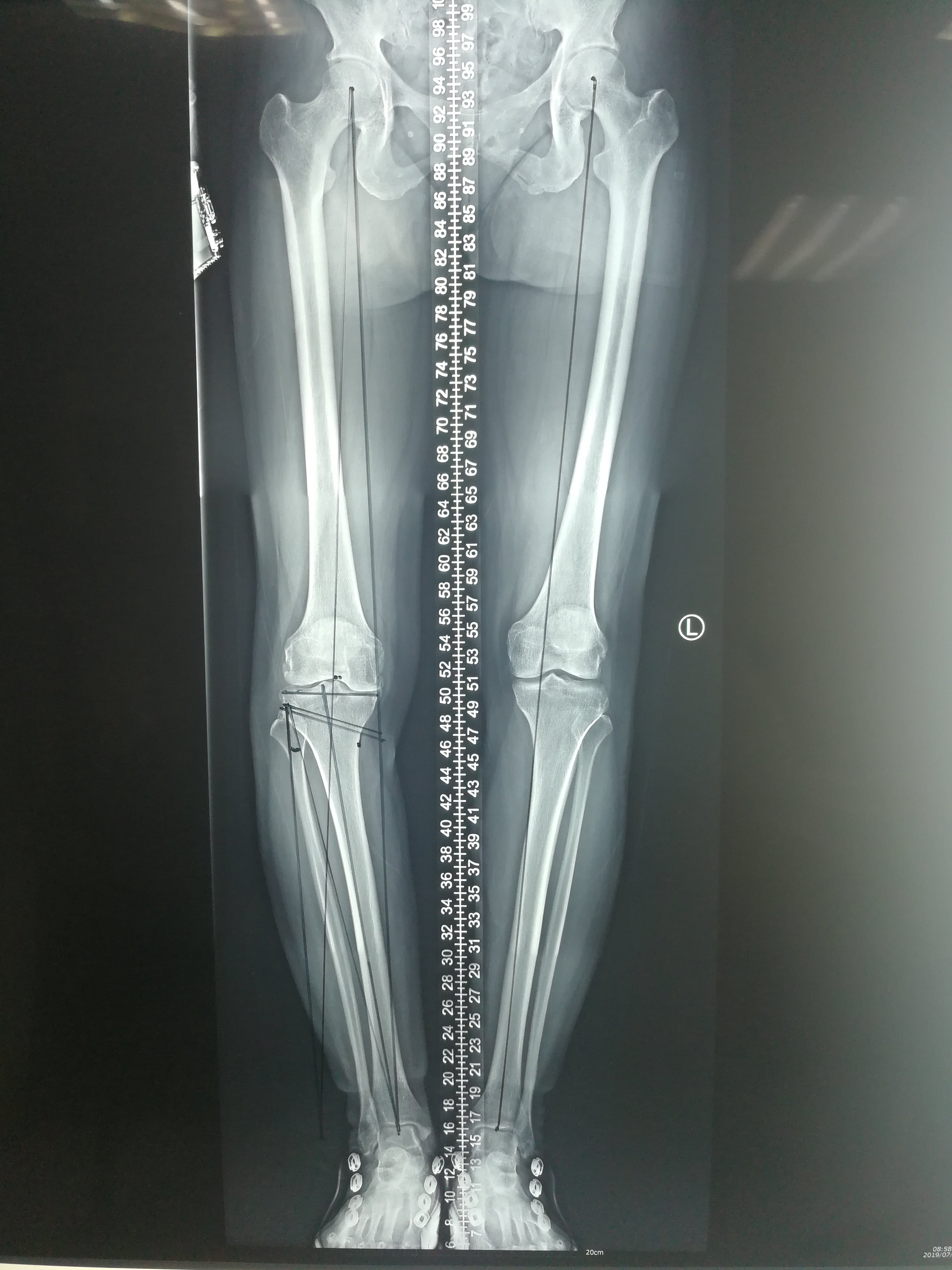 术前双下肢全长位片提示右膝关节轻度内翻畸形,内侧关节间隙变窄,术前