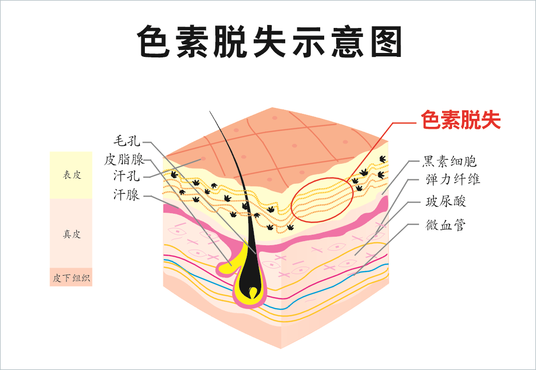 色素缺失生活中较为少见,多发生于深度烧伤后,所以,预防的重点应在