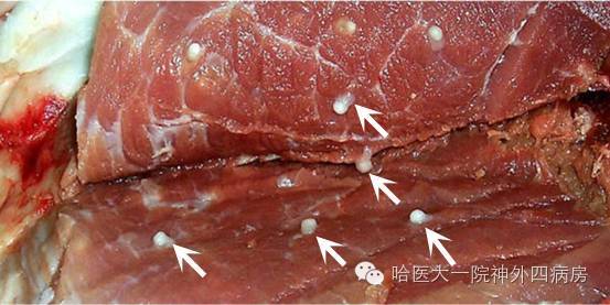 米猪肉是指含有猪肉绦虫囊尾蚴的猪肉,表现为在猪肉中有乳白色,米粒