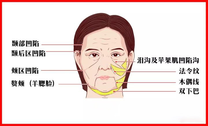 一, 鼻唇沟(法令纹)的加深因素和矫正方法下面就大致介绍下人类衰老