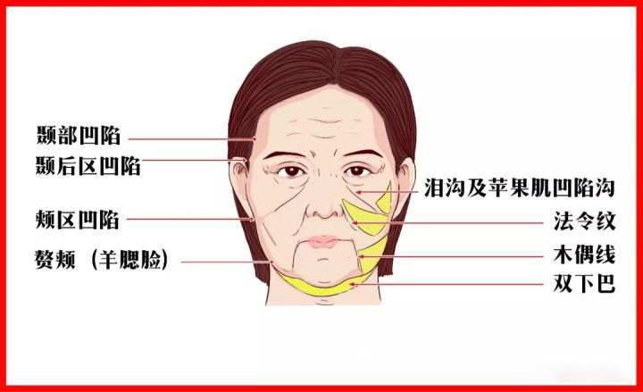 面部松弛下垂 法令纹,木偶纹,泪沟明显怎么去除呢?