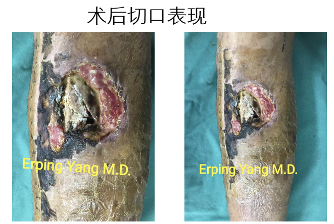 治疗相对棘手,一旦不能及时有效控制感染,极易产生慢性骨髓炎,   导致