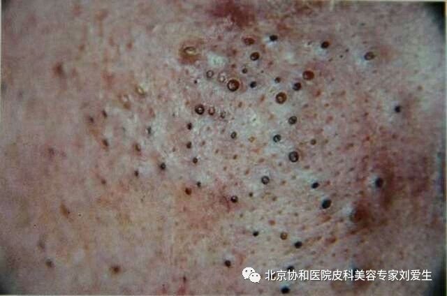 中度,丘疹,脓疱都有,量增多,而且从粉刺到丘疹,从丘疹到脓疱转化,皮损
