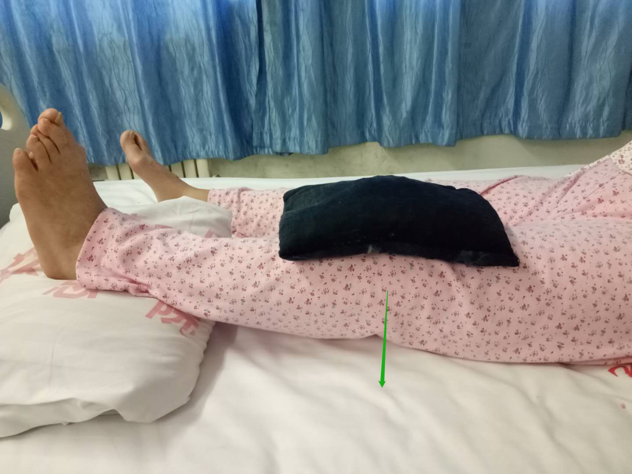 人工膝关节置换手术后康复锻炼及注意事项