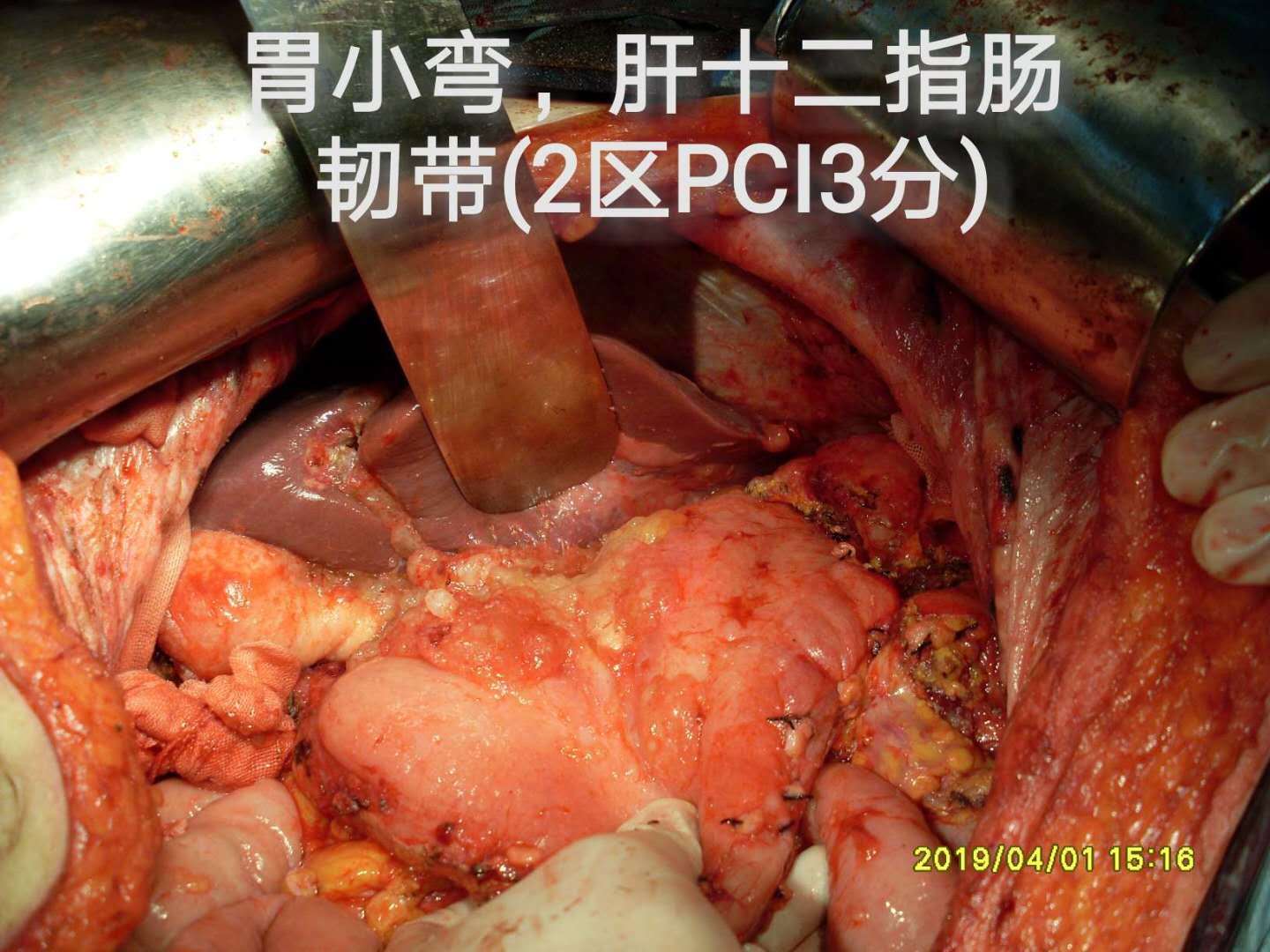 病例(34)--腹水查因提示阑尾恶性肿瘤腹腔转移