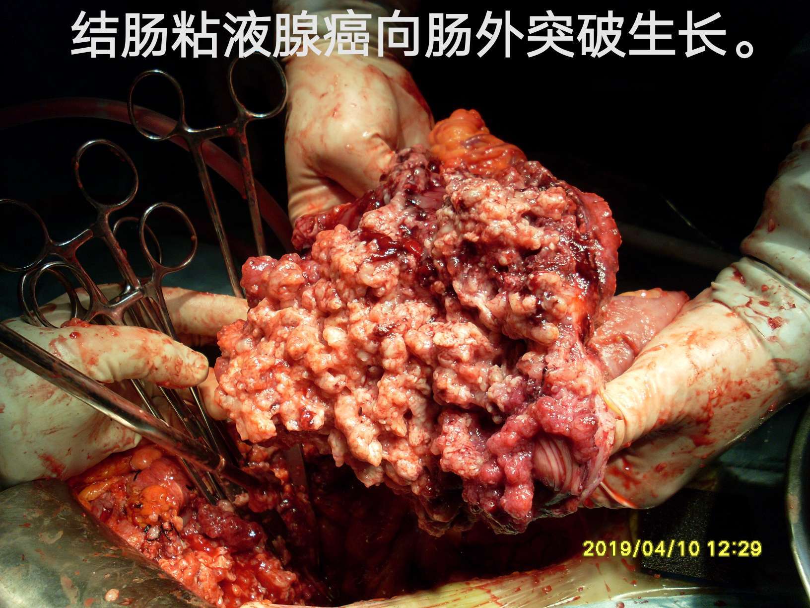 病例(40)--结肠肝曲粘液腺癌突破肠管向外生长!