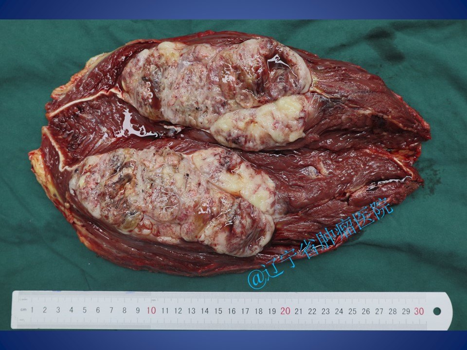 股部前侧肌群软组织肉瘤手术病例