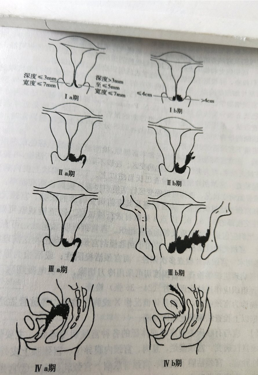 宫颈癌临床分期图