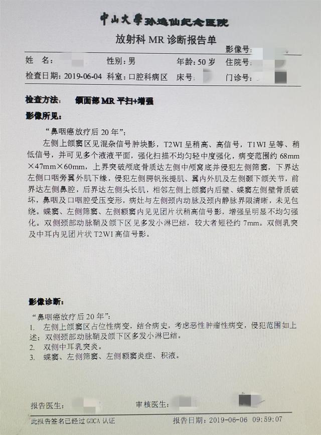 一例鼻咽癌放疗诱导的左上颌颅底骨肉瘤较为棘手的病例