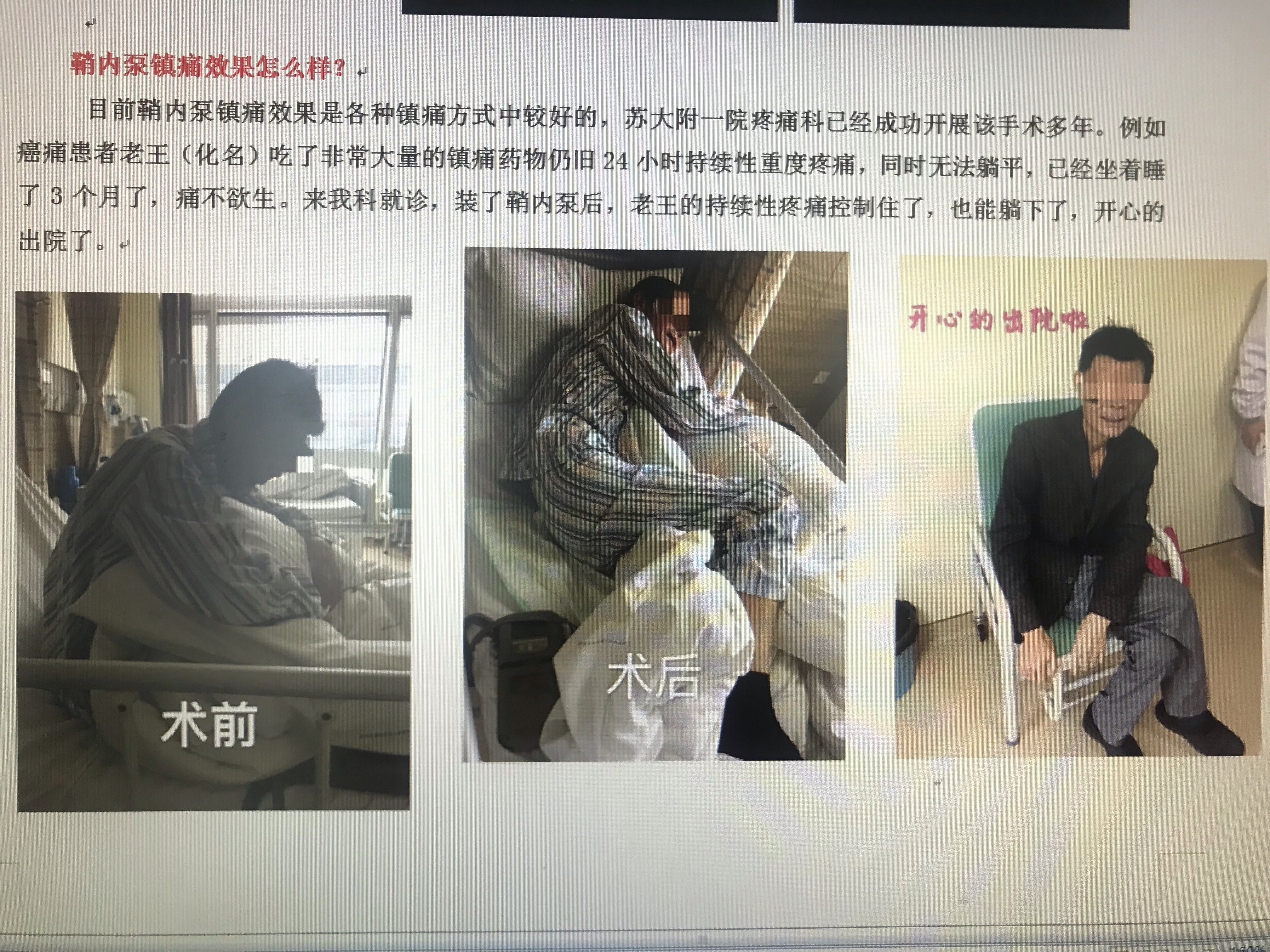 鞘内吗啡泵置入帮助癌痛患者鞘内吗啡泵的工作原理是将一根极细的