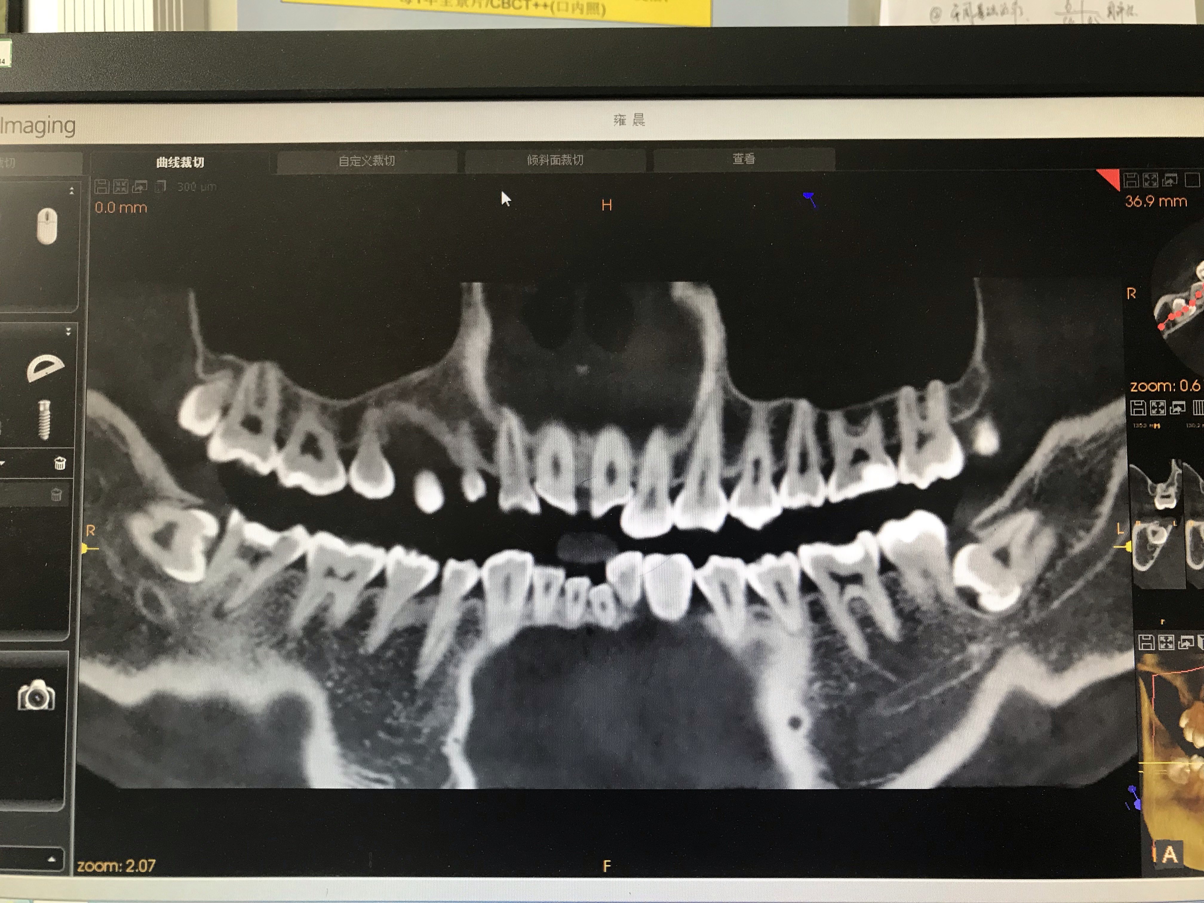 为啥【拔智齿】收费差别这么大?难道是牙医乱