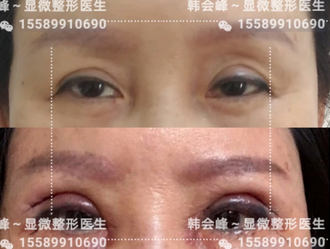 术前双眼皮不对称,睁眼无力,眼窝重度凹陷,外眼角下垂!