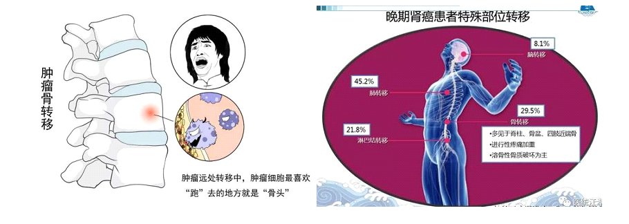 肾癌发生脊柱转移该怎么治疗