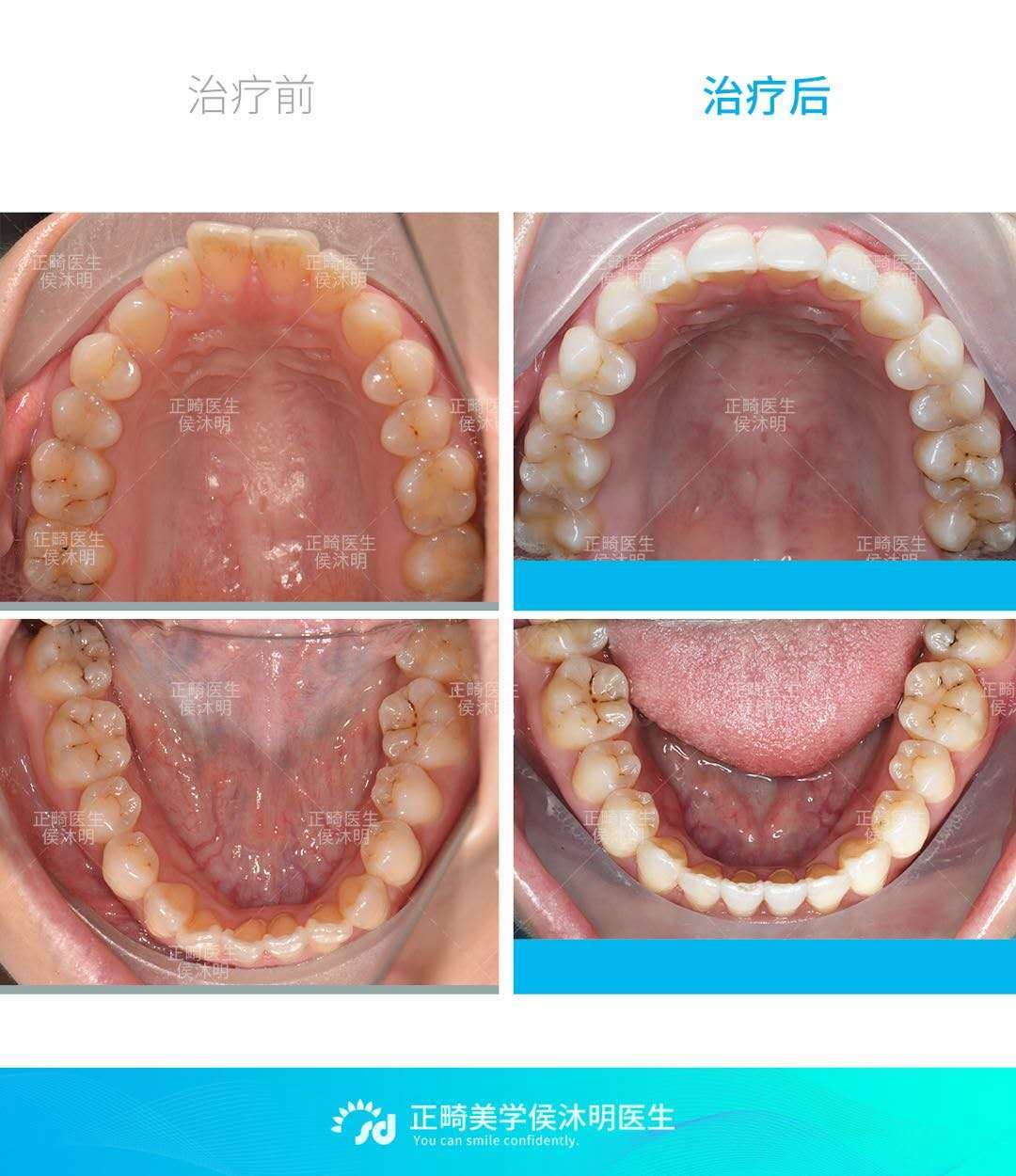 隐适美非拔牙矫正牙性前突案例分享_牙颌畸形