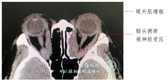 graves眼病系列病例④眼眶减压手术之三壁减压