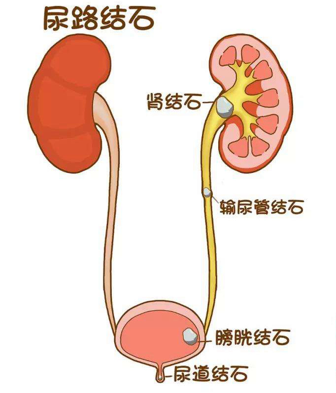 但在泌尿外科专科,常常是根据结石所在的位置分为肾结石,输尿管结石