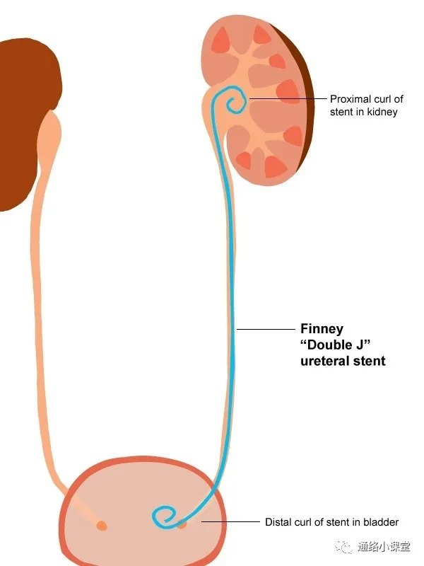 浅谈输尿管支架